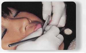 ホワイトニングについて