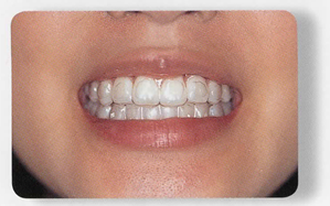 ホワイトニングについて